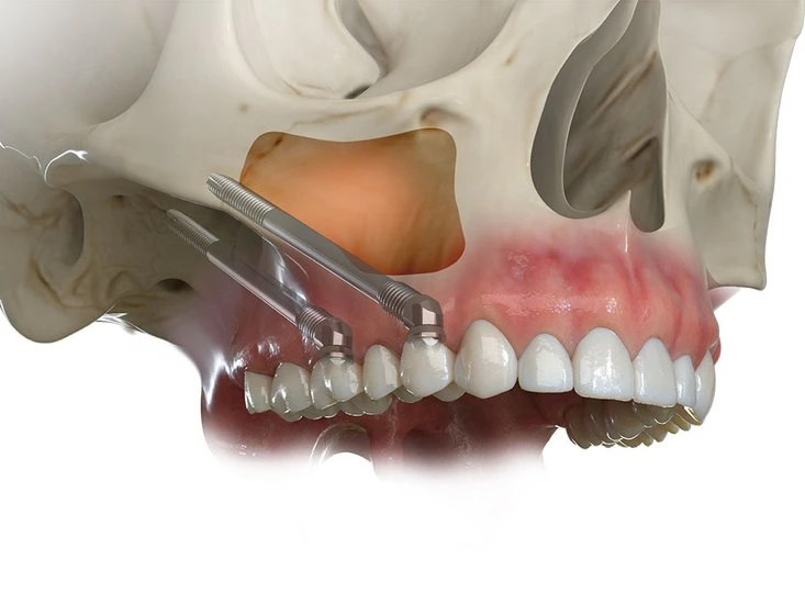 Zygomatic implants