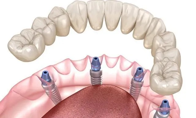 Digital implant planning