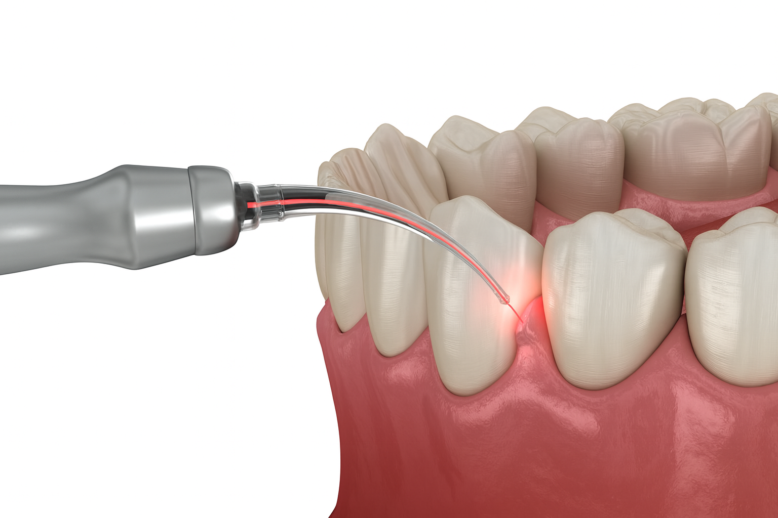 Laser assisted implant