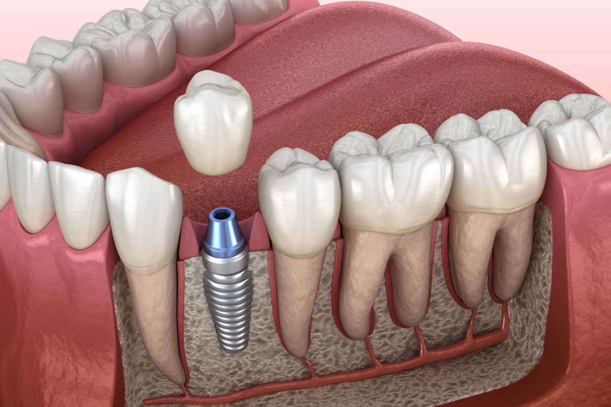 Single tooth implant
